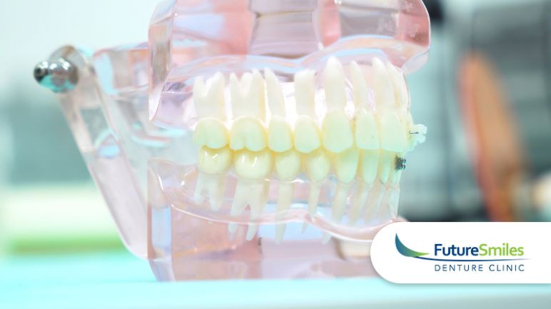  Snap-On Denture Implants: A Comprehensive Review